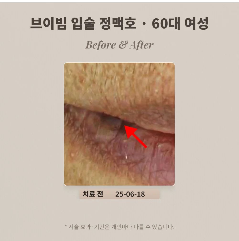60대 여성 입술 정맥호 브이빔 치료 전 확대