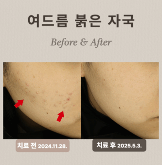 여드름 붉은자국